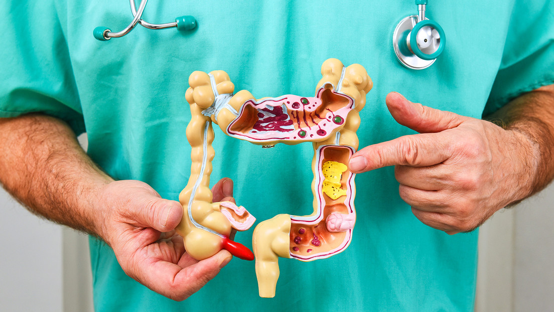 Este el posible ‘culpable’ del alarmante aumento de cáncer de colon en jóvenes