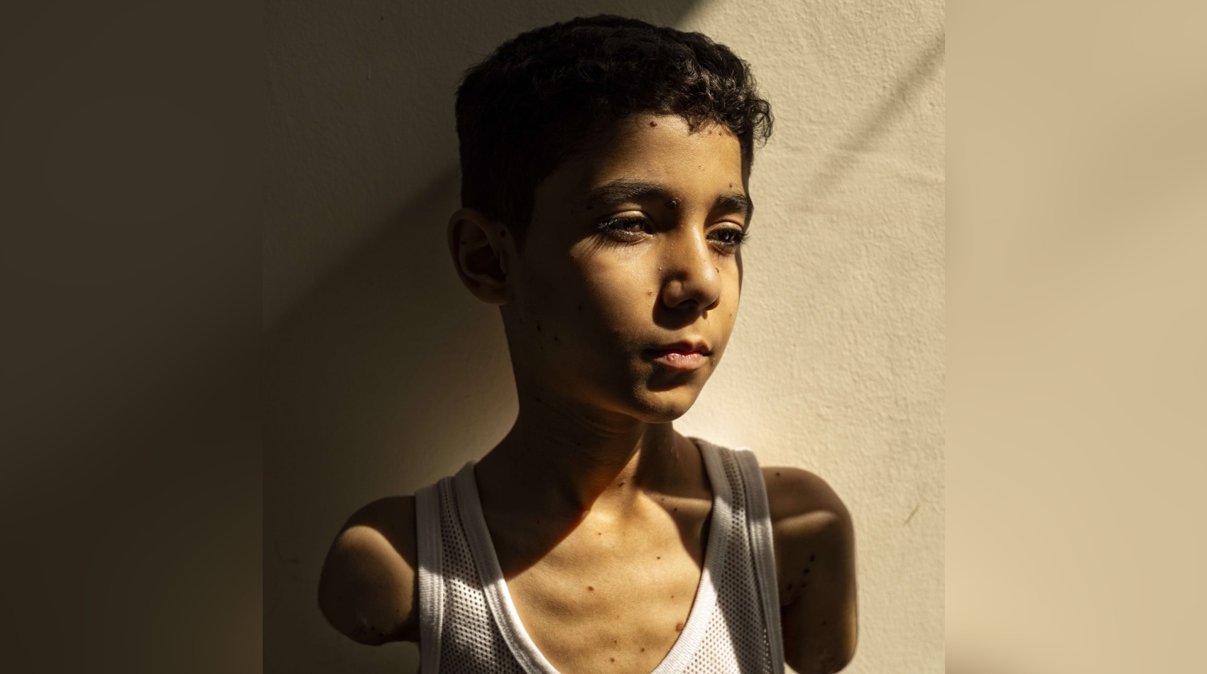 Retrato de un niño palestino que perdió ambos brazos es la Foto del Año de World Press Photo