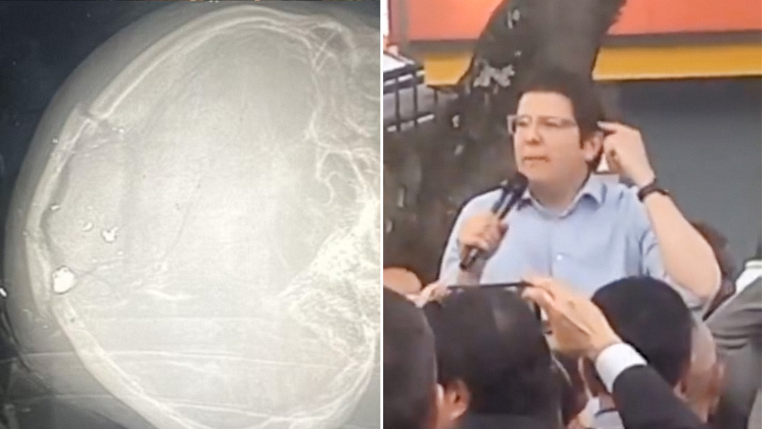 FOTO: Revelan supuesta radiografía del cráneo de Miguel Uribe