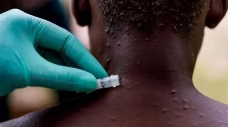 África reporta más de 4 mil muertes por cólera y mpox en lo que va de 2025