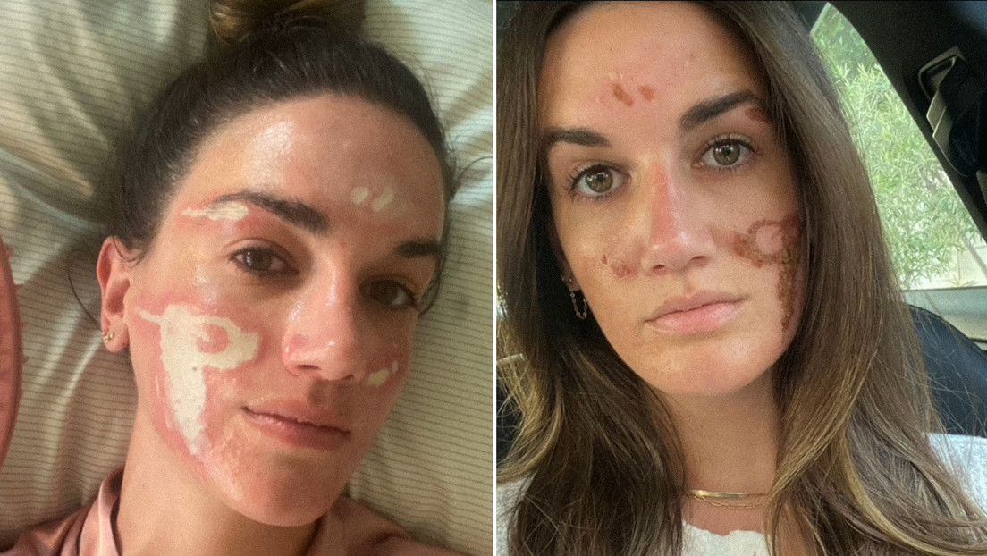 Denuncia a esteticista de famosos por haberle “desfigurado” el rostro de manera permanente